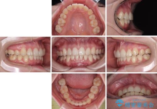 上下の八重歯とクロスバイト ワイヤー装置での抜歯矯正の治療後