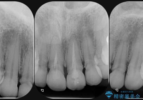 [ 審美歯科 ] 前歯セラミック治療の再治療の治療前