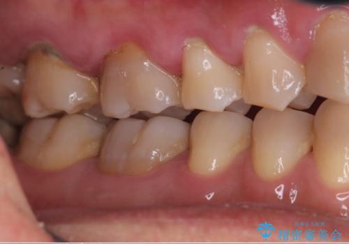 歯周病治療とエアーフローの治療前
