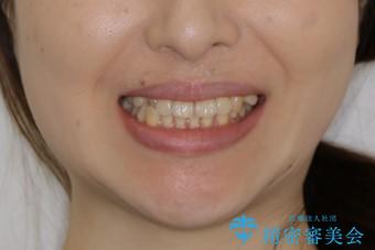 最小限の来院回数で歯並びを改善:インビザライン治療の治療前(顔貌)