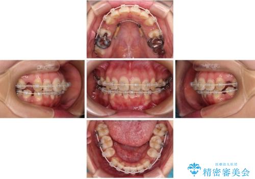 口元の突出感を改善したい。リンガルアーチを併用した抜歯矯正の治療中