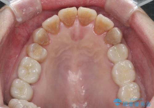 食いしばりが強い 歯周病全顎治療の治療後