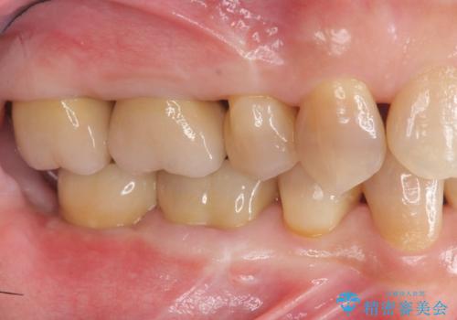 食いしばりが強い 歯周病全顎治療の治療後
