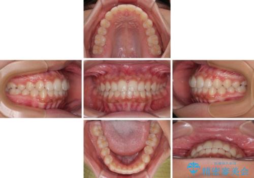 気になるすきっ歯を短期間で改善　インビザライン矯正の治療中