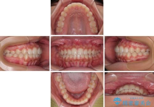 気になるすきっ歯を短期間で改善 インビザライン矯正の治療中