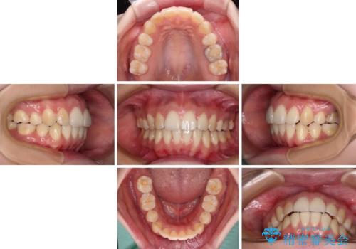 後戻りをインビザラインでスッキリした口元にの治療中