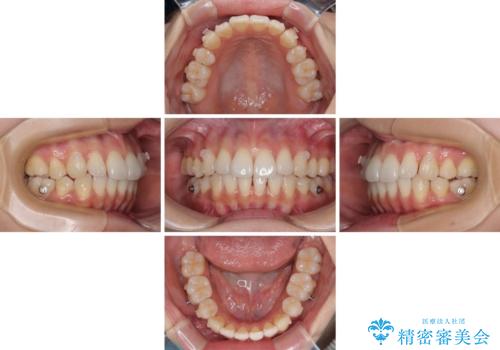 抜歯矯正の軽度後戻りを解消 インビザライン矯正の治療中