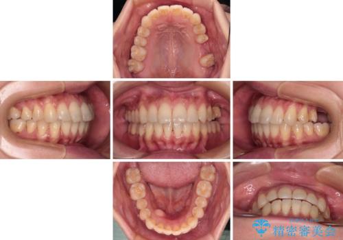 インビザラインによる矯正治療と奥歯のインプラント治療の治療中