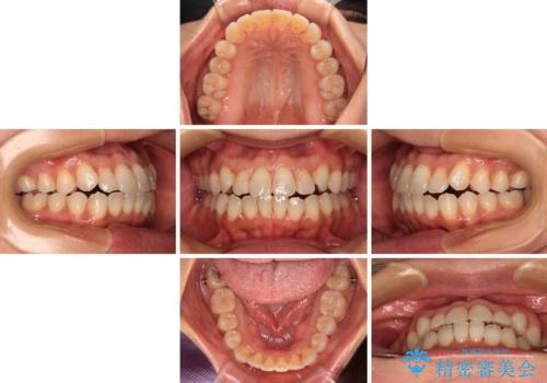 前歯のクロスバイト インビザラインによる矯正治療の治療中