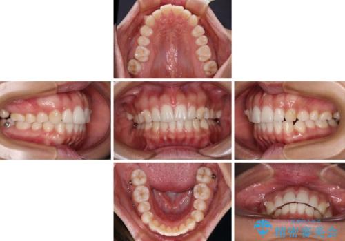 【モニター】突出した前歯 補助装置を併用したインビザライン矯正の治療中