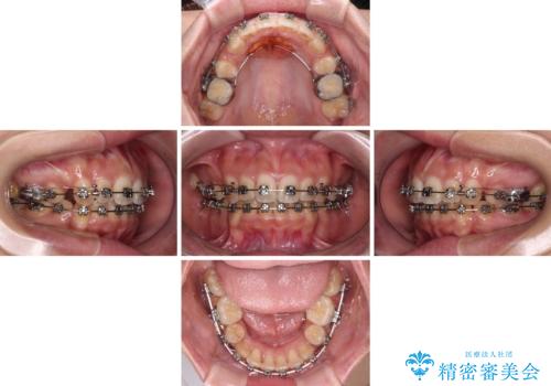 八重歯と上顎前突 ワイヤー装置での抜歯矯正の治療中