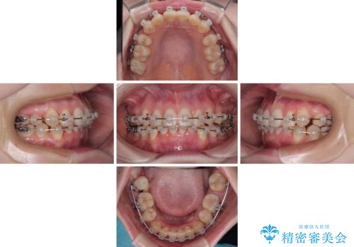 上下の八重歯とクロスバイト ワイヤー装置での抜歯矯正の治療中