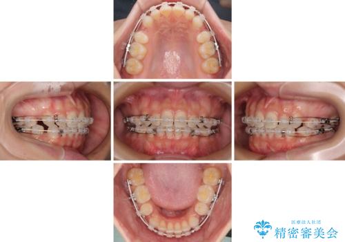 前歯のデコボコとクロスバイト ワイヤー装置での抜歯矯正の治療中