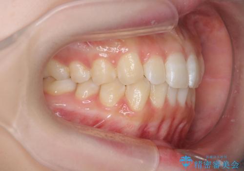 前歯のねじれを治したい マウスピース矯正治療の治療後