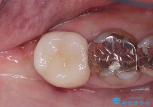 【オールセラミッククラウン】銀歯の下が虫歯に!の症例 治療後