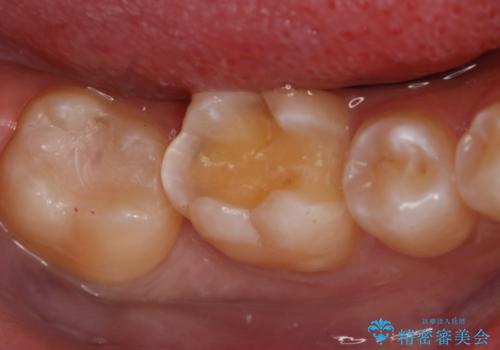 銀歯を白くしたい フルジルコニアクラウンとセラミックインレーの治療中