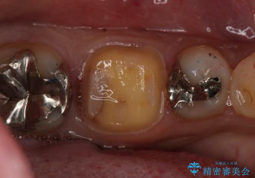 フルジルコニアクラウンによる銀歯のやり変えの治療中