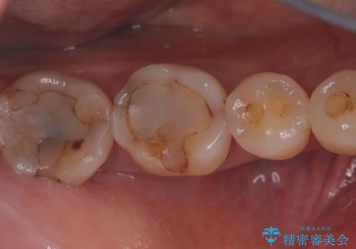 【セラミックインレー】プラスチックの劣化が気になるの治療前