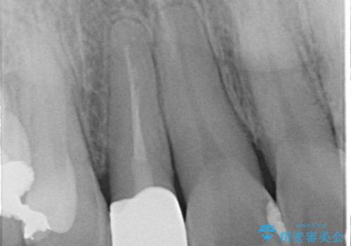前歯の見た目が気になる|オールセラミッククラウンで見た目を改善の治療後