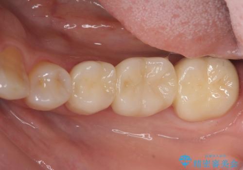 抜歯後の補綴 セラミックブリッジ治療の治療後