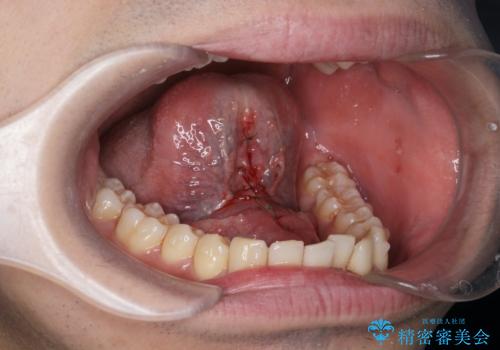 滑舌の改善 舌小帯の形成術の治療中