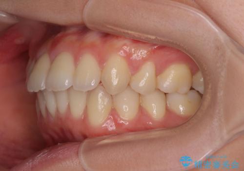 突き出た前歯の改善!マウスピースで再矯正の治療後