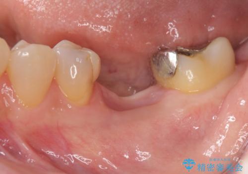 抜歯後の補綴 セラミックブリッジ治療の治療前