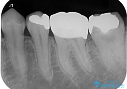 フルジルコニアクラウンによる銀歯のやり変えの治療後