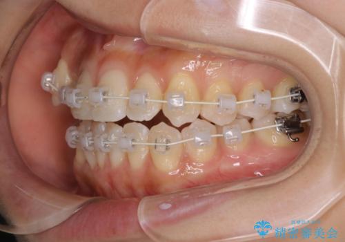 【審美装置】八重歯気になるの治療中