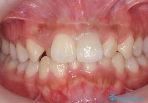 前歯の見た目が気になる。の治療後