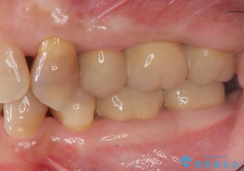 食いしばりが強い 歯周病全顎治療の治療後