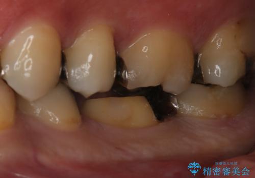 フルジルコニアクラウンによる銀歯のやり変えの治療中