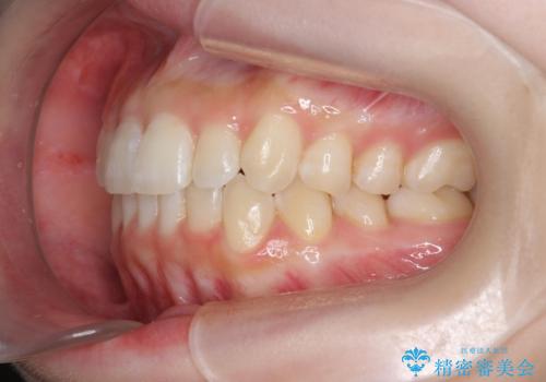 前歯のねじれを治したい マウスピース矯正治療の治療後
