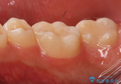 銀歯を白くしたい フルジルコニアクラウンとセラミックインレーの治療後