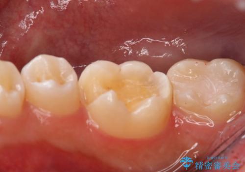 銀歯を白くしたい フルジルコニアクラウンとセラミックインレーの治療中