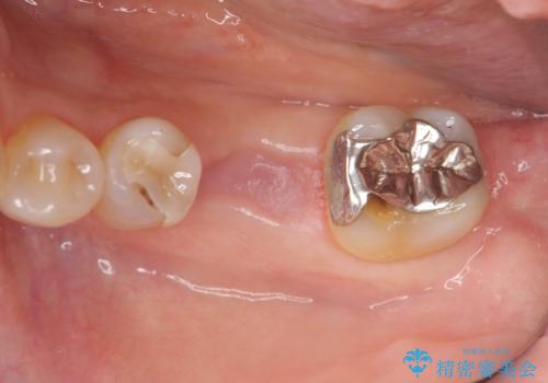 抜歯後の補綴 セラミックブリッジ治療の治療前