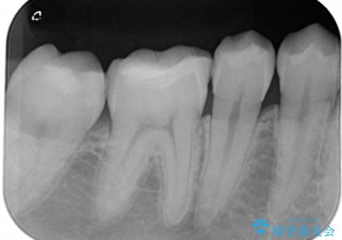 銀歯を白くしたい フルジルコニアクラウンとセラミックインレーの治療後