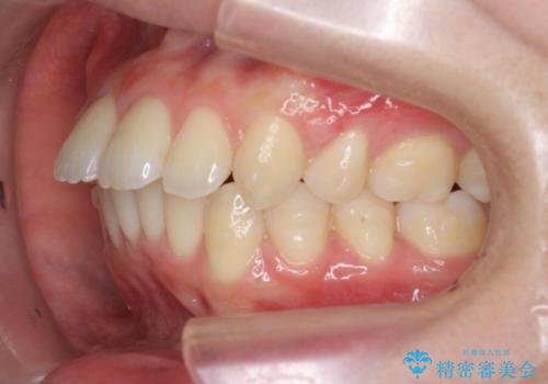 突き出た前歯の改善!マウスピースで再矯正の治療中