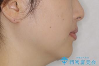 最小限の来院回数で歯並びを改善:インビザライン治療の治療前(顔貌)