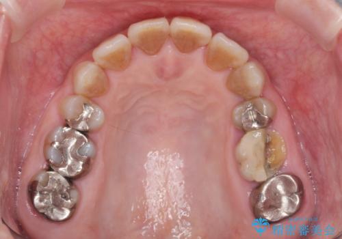 食いしばりが強い 歯周病全顎治療の治療前