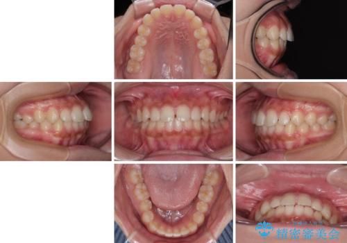 気になるすきっ歯を短期間で改善　インビザライン矯正の治療前