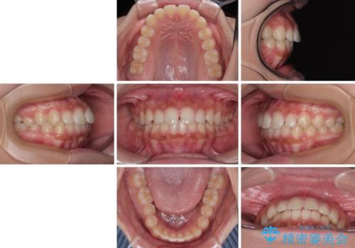 気になるすきっ歯を短期間で改善 インビザライン矯正の治療前