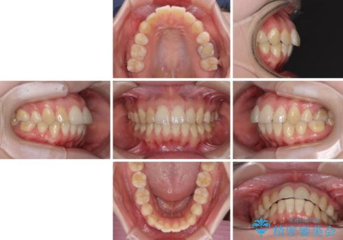 後戻りをインビザラインでスッキリした口元にの治療前