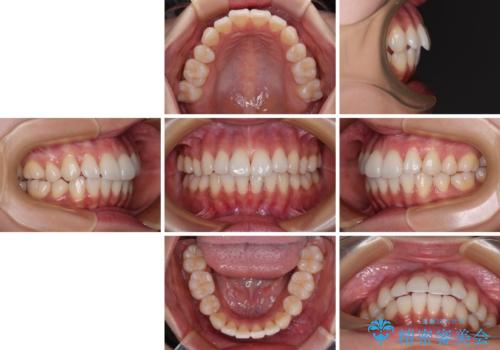 抜歯矯正の軽度後戻りを解消 インビザライン矯正の治療前