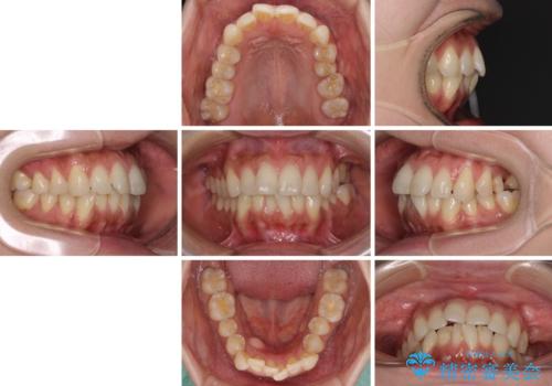 インビザラインによる矯正治療と奥歯のインプラント治療の治療前