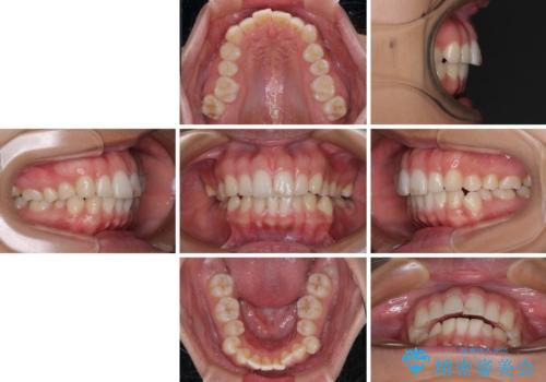 【モニター】突出した前歯 補助装置を併用したインビザライン矯正の治療前