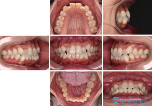 前歯のクロスバイト インビザラインによる矯正治療の治療前