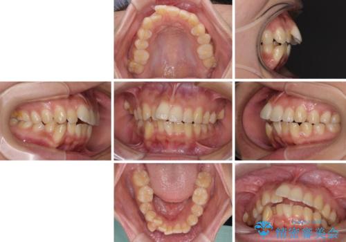 八重歯と上顎前突 ワイヤー装置での抜歯矯正の治療前