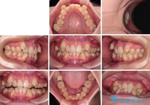 上下の八重歯とクロスバイト ワイヤー装置での抜歯矯正の治療前