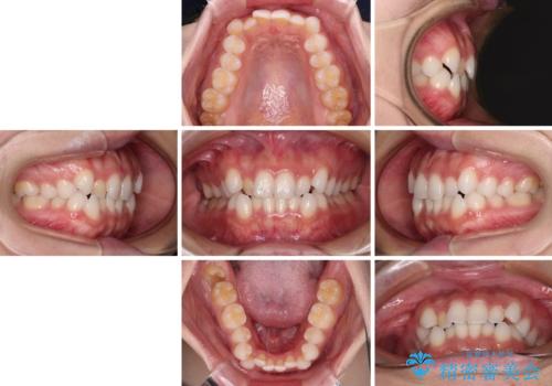 前歯のデコボコとクロスバイト ワイヤー装置での抜歯矯正の治療前